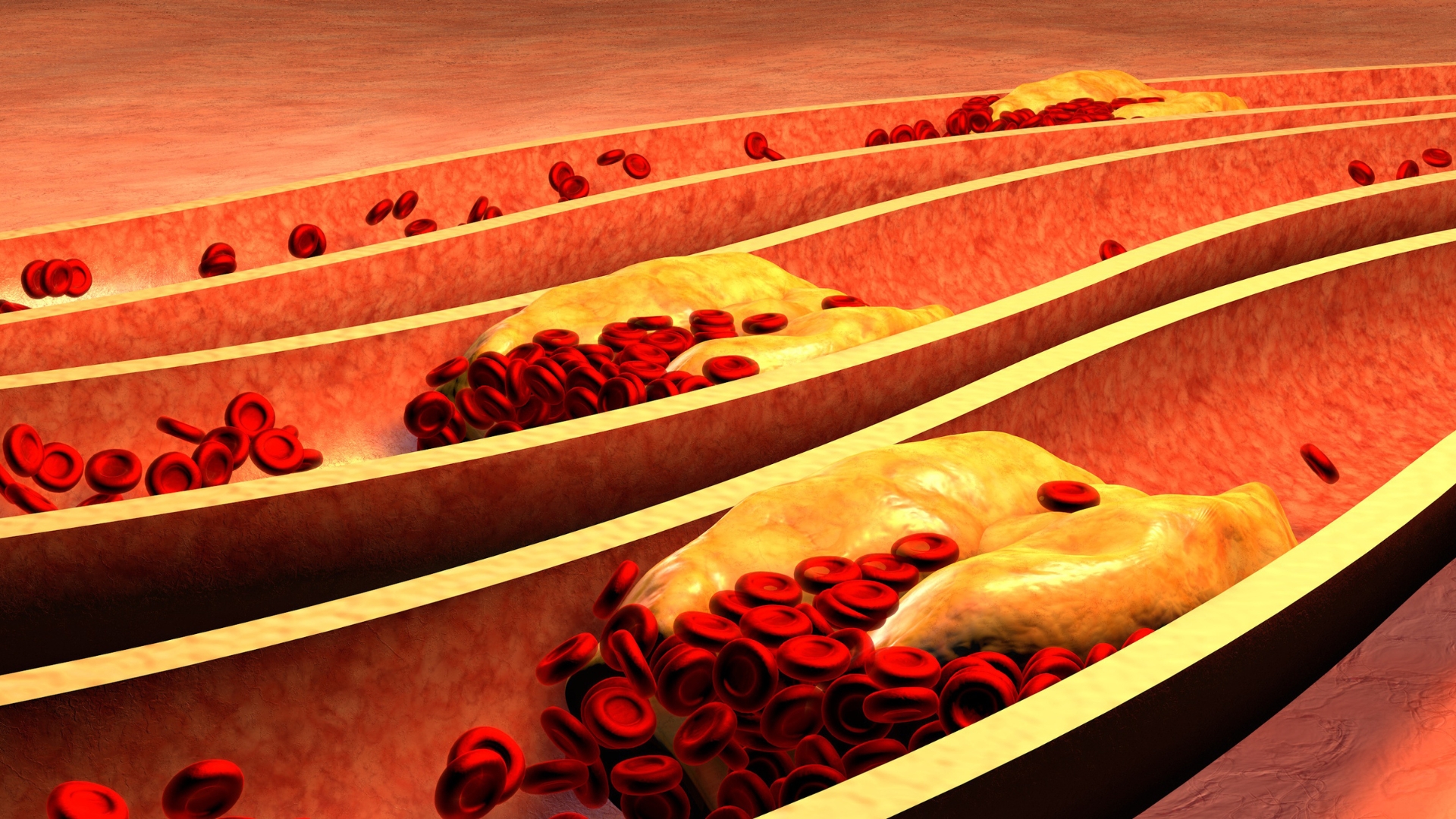 Entzündung Arteriosklerose Plaque