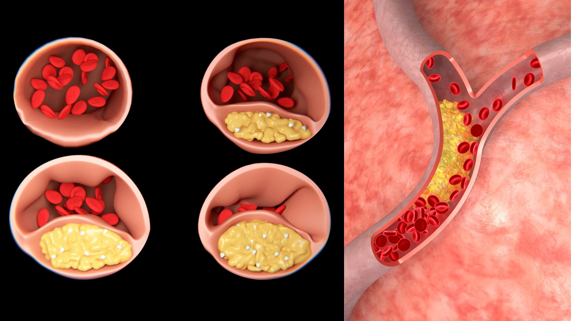Atherosklerose Arteriosklerose Lipideinlagerung